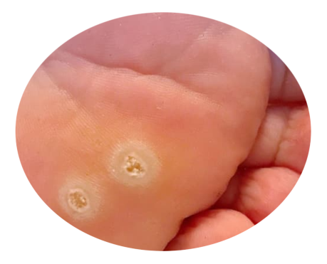 atencion con quimicos verruga plantar o como se comoce papiloma plantar